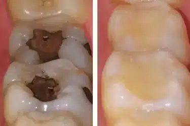 Cambio de empastes de amalgama por empastes estéticos de resina en Madrid, Dr. Ferrer