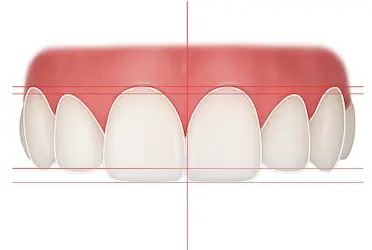 Contorneado dental en Madrid para mejorar la forma y simetría de los dientes por Dr. Ferrer