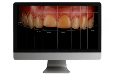 Diseño digital de sonrisa en Madrid con planificación estética dental en ordenador por Dr. Ferrer