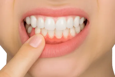 encías inflamadas y enrojecidas como consecuencia de una gingivitis no tratada