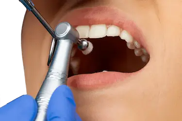 Higiene dental profesional para eliminar sarro y reducir el mal aliento