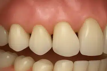 Dientes separados y con movilidad por pérdida de soporte óseo causada por periodontitis