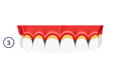 Encías retraídas con raíces expuestas y pérdida ósea por periodontitis avanzada