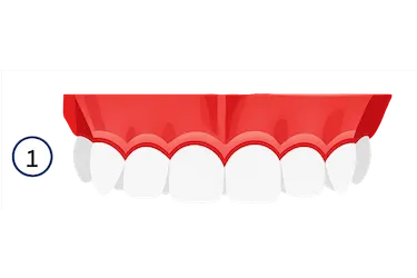 Encías enrojecidas y retraídas, signos iniciales de periodontitis leve