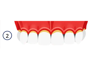 Dientes con encías inflamadas y bolsas periodontales que indican periodontitis moderada