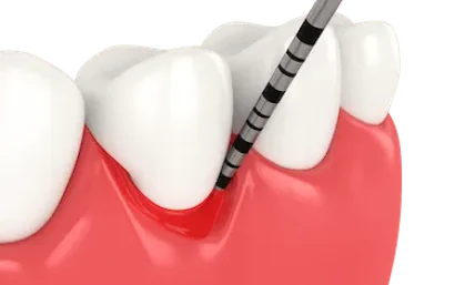 Ilustración 3D de periodontitis con encías inflamadas y acumulación de sarro dental
