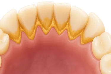 Sarro amarillo endurecido en la cara interna de los dientes inferiores anteriores