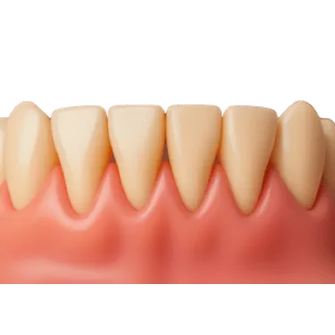 Sonda periodontal midiendo bolsas en encía inflamada por periodontitis
