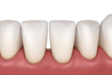 Encías superiores inflamadas y sangrantes, signo visible de periodontitis avanzada