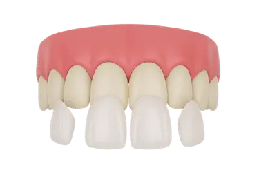 Colocación de carillas como tratamiento de estética dental realizado por el Dr. Ferrer