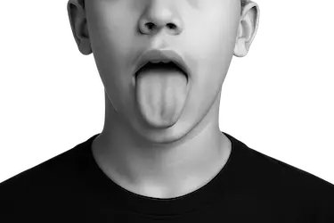 Lengua seca en joven, signo frecuente de xerostomía asociada a halitosis