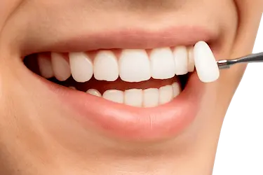 Colocación de carilla dental en tratamiento de estética dental en Madrid con el Dr. Ferrer