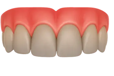 Dientes grises y apagados que pueden tratarse con blanqueamiento dental en Madrid