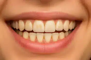 Dientes con manchas de café tratables con blanqueamiento dental en Madrid