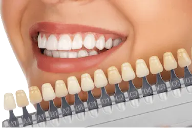 Comparativa de tonos dentales en estética dental en Madrid en Clínica Dental Medics Dr. Ferrer