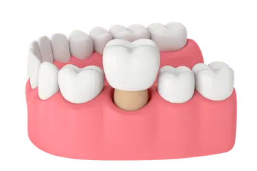 Funda dental estética sobre diente natural en tratamiento de estética dental en Madrid Dr. Ferrer