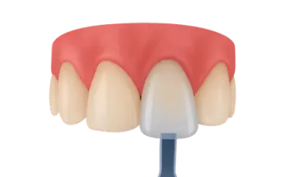 Colocación de carilla dental sobre incisivo superior en Madrid