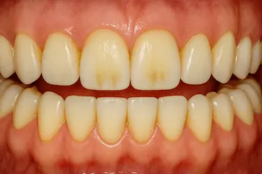Dientes manchados que mejoran tras una limpieza bucal profesional con profilaxis