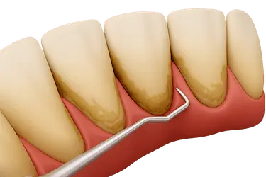 Sarro dental acumulado con solución mediante tartrectomía y limpieza oral en Madrid