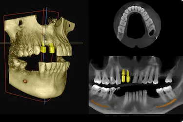 Estudio 3D de ambas arcadas con planificación virtual de implantes y análisis del hueso