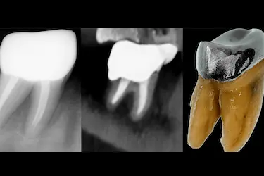 Comparativa radiográfica y 3D de un diente tras tratamiento de endodoncia