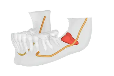 Vista 3D de la mandíbula con nervio dentario inferior y lesión en zona posterior