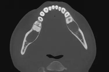 Corte axial del maxilar superior en TAC dental 3D para planificación de tratamientos