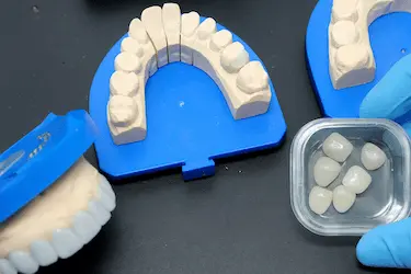 Modelos dentales con carillas dentales de porcelana y composite listos para colocación clínica