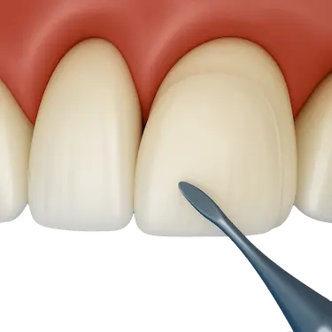 Aplicación de carilla de composite en diente frontal durante tratamiento estético dental en Madrid