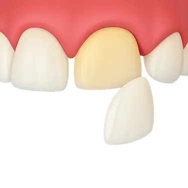 Carilla de porcelana colocada sobre diente amarillento para mejorar la estética dental en Madrid