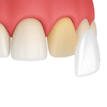 Carillas de zirconio colocadas en dientes para mejorar la estética dental en Madrid