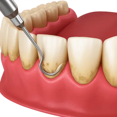 Limpieza dental interproximal con cureta para eliminar sarro y placa bacteriana
