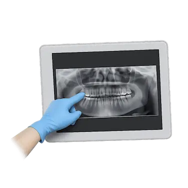 Radiografía dental en valoración previa a limpieza bucal profesional