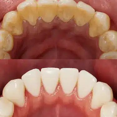 Antes y después de una limpieza dental profesional para eliminar sarro en Madrid