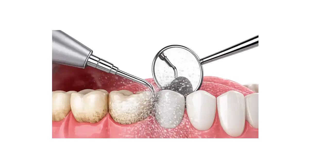 Instrumento odontológico realizando limpieza dental profesional en Madrid en la Clínica Dr. Ferrer