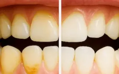 Antes y después de una limpieza dental en Madrid en la Clínica Dental del Dr. Ferrer