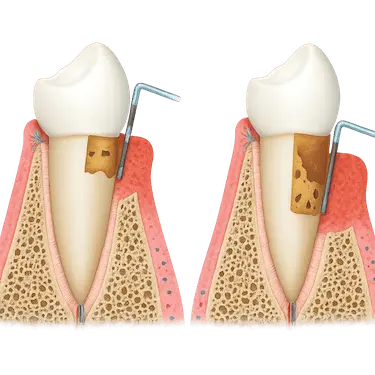 Ilustración dental mostrando tartrectomía durante una limpieza dental profunda con curetas en encías
