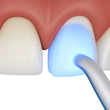Aplicación de luz azul sobre microcarilla dental en tratamiento estético en Madrid