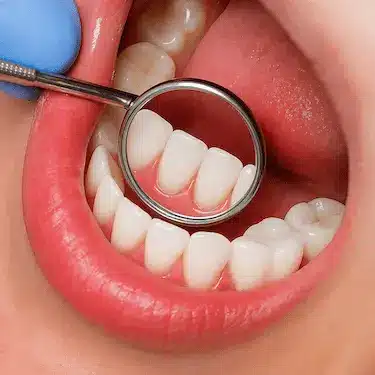 Revisión odontológica con espejo dental tras una limpieza dental profesional en Madrid