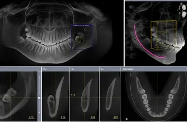 Cortes de TAC dental 3D para localizar y evaluar dientes incluidos