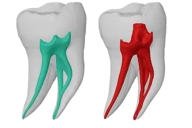 Modelo 3D de TAC dental con conductos radiculares para planificación endodóntica