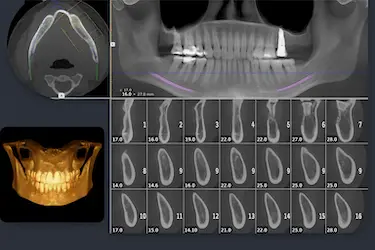 Corte 3D de TAC dental con planificación de implantes y análisis del hueso maxilar