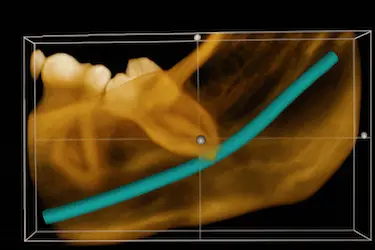 Reconstrucción 3D de TAC dental para analizar la posición de las muelas del juicio