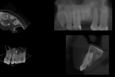 TAC dental 3D para evaluar regeneración ósea en cirugías dentales