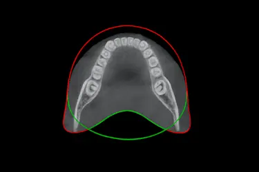 Corte transversal de TAC dental para planificar distintos tratamientos odontológicos