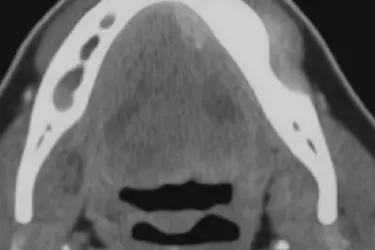 Corte axial de TAC dental que detecta una lesión tumoral en la región maxilar
