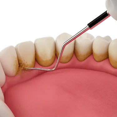 Instrumento de ultrasonido eliminando sarro en una limpieza dental profesional en Madrid
