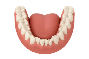 Arcada inferior con dientes apiñados para explicar tratamiento Invisalign en Murcia