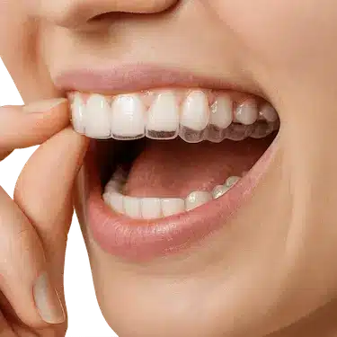 Paciente colocando alineador invisible durante tratamiento de ortodoncia Invisalign en Madrid