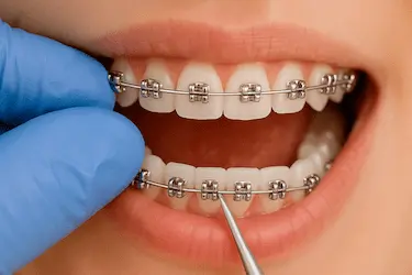 Aparato dental metálico en paciente durante tratamiento de ortodoncia en Madrid con el Dr. Ferrer